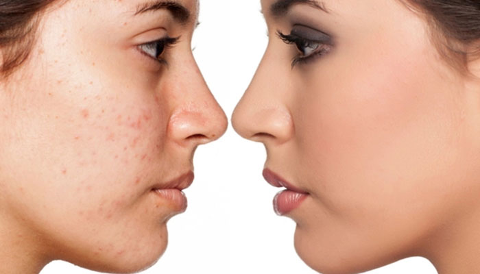 جوانسازی پوست و درمان انواع اسکارها در کلینیک چهرزاد