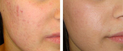 جوانسازی پوست و درمان انواع اسکارها - کلینیک چهرزاد