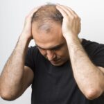 کاشت مو برای چه کسانی جواب نمی‌دهد؟ ۹ دلیل شکست کاشت مو