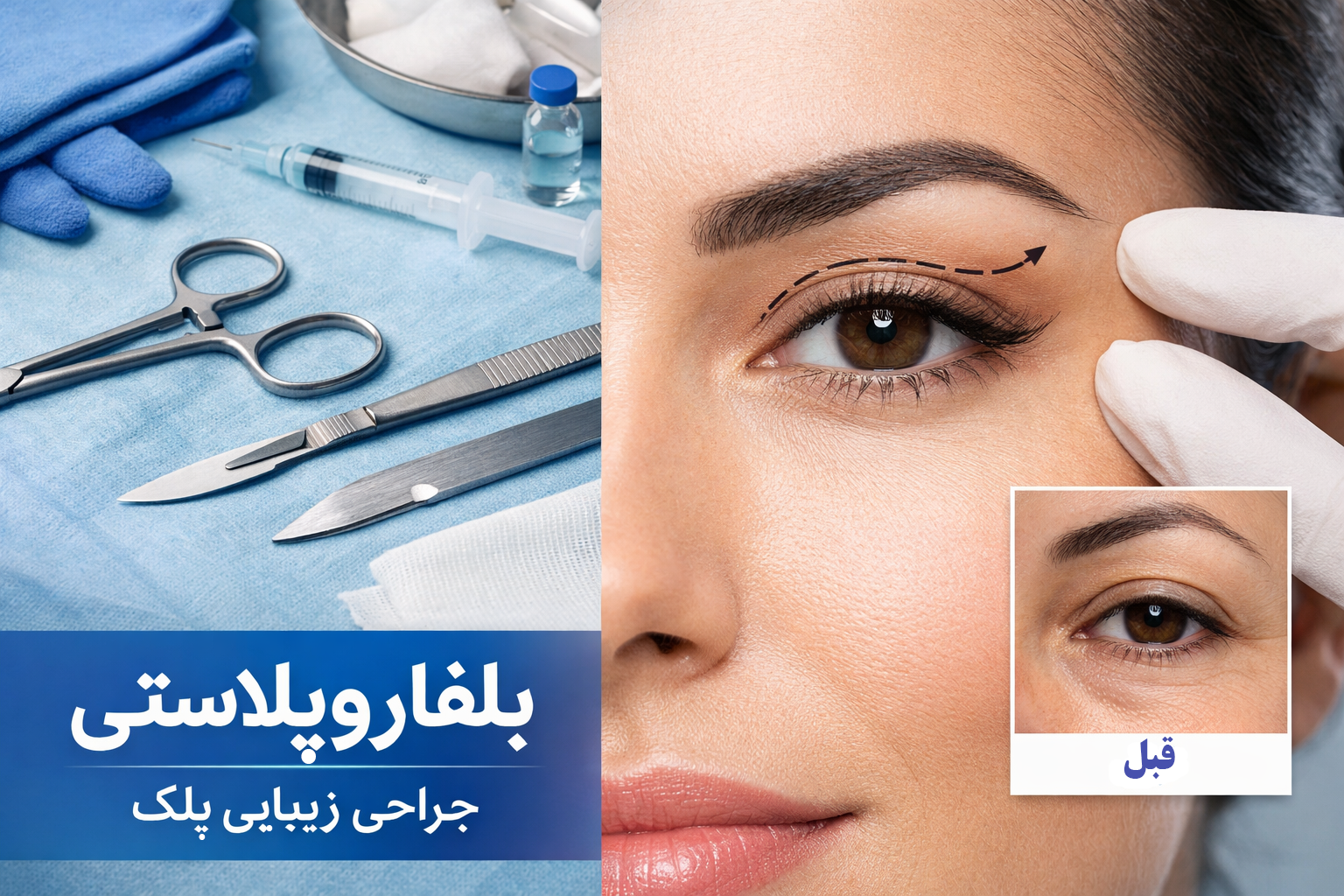 بلفاروپلاستی